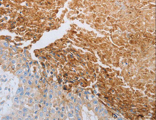 RTN4 / Nogo Antibody - Immunohistochemistry of paraffin-embedded Human esophagus cancer using RTN4 Polyclonal Antibody at dilution of 1:40.