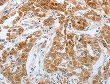 RTN4 / Nogo Antibody - Immunohistochemistry of paraffin-embedded Human lung cancer using RTN4 Polyclonal Antibody at dilution of 1:40.