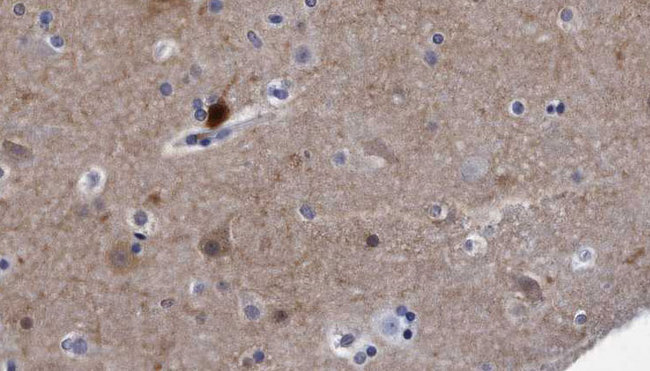 RTN4 / Nogo Antibody - 1:100 staining human brain carcinoma tissue by IHC-P. The sample was formaldehyde fixed and a heat mediated antigen retrieval step in citrate buffer was performed. The sample was then blocked and incubated with the antibody for 1.5 hours at 22°C. An HRP conjugated goat anti-rabbit antibody was used as the secondary.
