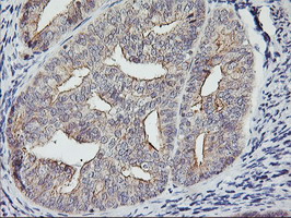 RTN4IP1 / NIMP Antibody - IHC of paraffin-embedded Adenocarcinoma of Human endometrium tissue using anti-RTN4IP1 mouse monoclonal antibody. (Heat-induced epitope retrieval by 10mM citric buffer, pH6.0, 100C for 10min).