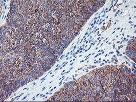 RTN4IP1 / NIMP Antibody - IHC of paraffin-embedded Carcinoma of Human bladder tissue using anti-RTN4IP1 mouse monoclonal antibody. (Heat-induced epitope retrieval by 10mM citric buffer, pH6.0, 100C for 10min).