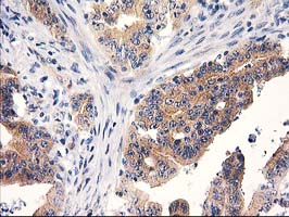 RTN4IP1 / NIMP Antibody - IHC of paraffin-embedded Adenocarcinoma of Human colon tissue using anti-RTN4IP1 mouse monoclonal antibody.