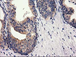RTN4IP1 / NIMP Antibody - IHC of paraffin-embedded Carcinoma of Human prostate tissue using anti-RTN4IP1 mouse monoclonal antibody.