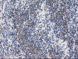 RTN4IP1 / NIMP Antibody - IHC of paraffin-embedded Human lymphoma tissue using anti-RTN4IP1 mouse monoclonal antibody.