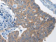 RTN4IP1 / NIMP Antibody - Immunohistochemistry of paraffin-embedded Human colorectal cancer tissue  using RTN4IP1 Polyclonal Antibody at dilution of 1:50(×200)