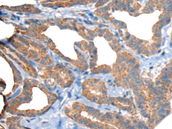 RTN4IP1 / NIMP Antibody - Immunohistochemistry of paraffin-embedded Human thyroid cancer tissue  using RTN4IP1 Polyclonal Antibody at dilution of 1:50(×200)