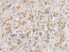 RTP4 / IFRG28 Antibody - Immunohistochemistry of paraffin-embedded Human liver cancer tissue  using RTP4 Polyclonal Antibody at dilution of 1:80(×200)