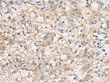 RTP4 / IFRG28 Antibody - Immunohistochemistry of paraffin-embedded Human liver cancer tissue  using RTP4 Polyclonal Antibody at dilution of 1:50(×200)