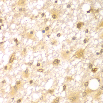 RUFY2 Antibody - Immunohistochemistry of paraffin-embedded human brain cancer tissue.