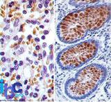 RUNX3 Antibody - Immunohistochemistry-Paraffin: RUNX3 Antibody (2B9G4) - Formalin-fixed, paraffin-embedded normal human spleen (left) and colon cancer tissue (right) stained with RUNX3 antibody (5 ug/ml), peroxidase-conjugate and DAB chromogen.  This image was taken for the unconjugated form of this product. Other forms have not been tested.
