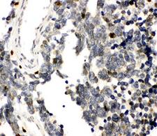 RUNX3 Antibody - IHC-P testing of RUNX3 antibody and human lung cancer