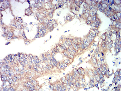 RUNX3 Antibody - Immunohistochemical analysis of paraffin-embedded stomach cancer tissues using RUNX3 mouse mAb with DAB staining.