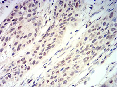 RUNX3 Antibody - Immunohistochemical analysis of paraffin-embedded esophageal cancer tissues using RUNX3 mouse mAb with DAB staining.