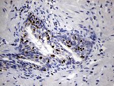 RUNX3 Antibody - Immunohistochemical staining of paraffin-embedded Carcinoma of Human prostate tissue using anti-RUNX3 mouse monoclonal antibody. (Heat-induced epitope retrieval by 1mM EDTA in 10mM Tris buffer. (pH8.5) at 120°C for 3 min. (1:500)