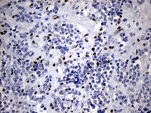 RUNX3 Antibody - Immunohistochemical staining of paraffin-embedded Human lymphoma tissue using anti-RUNX3 mouse monoclonal antibody. (Heat-induced epitope retrieval by 1mM EDTA in 10mM Tris buffer. (pH8.5) at 120°C for 3 min. (1:500)