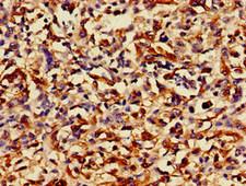 RUNX3 Antibody - Immunohistochemistry of paraffin-embedded human melanoma cancer at dilution of 1:100