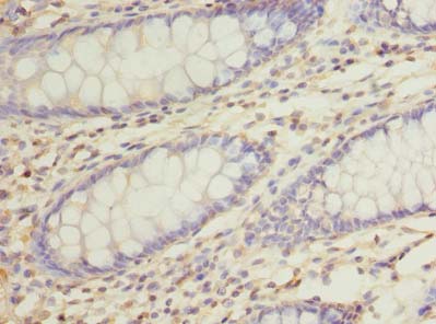 RUSC1 Antibody - Immunohistochemistry of paraffin-embedded human colon cancer using antibody at dilution of 1:100.