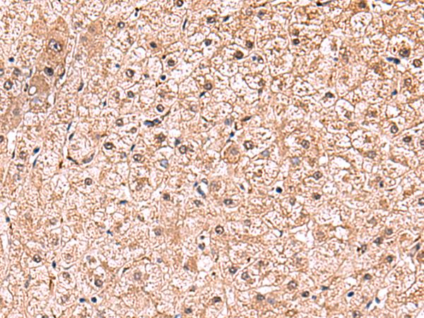 RUSC1 Antibody - Immunohistochemistry of paraffin-embedded Human liver cancer tissue  using RUSC1 Polyclonal Antibody at dilution of 1:90(×200)