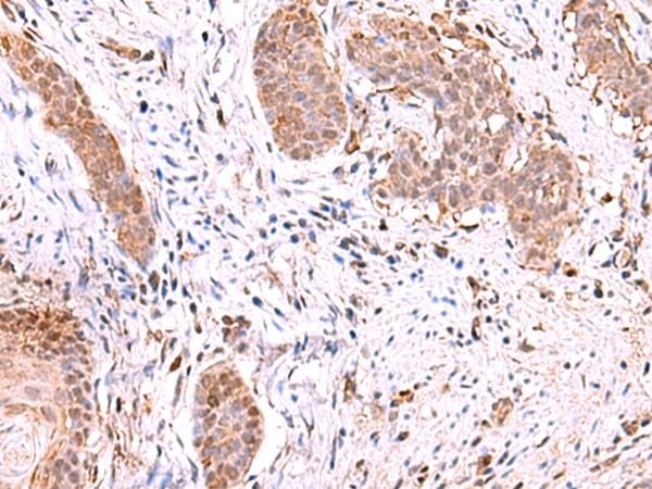 RUSC1 Antibody - Immunohistochemistry of paraffin-embedded Human esophagus cancer tissue  using RUSC1 Polyclonal Antibody at dilution of 1:90(×200)