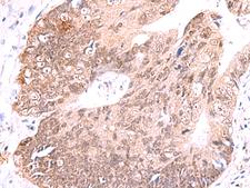 RUSC1 Antibody - Immunohistochemistry of paraffin-embedded Human colorectal cancer tissue  using RUSC1 Polyclonal Antibody at dilution of 1:65(×200)