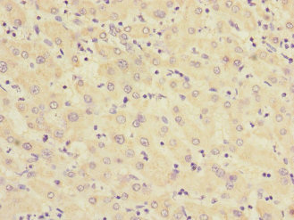 RXFP3 Antibody - Immunohistochemistry of paraffin-embedded human liver cancer at dilution 1:100
