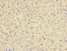 RXFP3 Antibody - Immunohistochemistry of paraffin-embedded human liver cancer at dilution 1:100