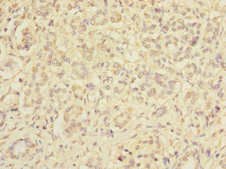 RXFP3 Antibody - Immunohistochemistry of paraffin-embedded human pancreatic cancer at dilution 1:100