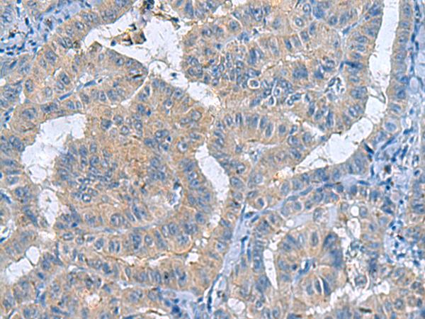 RXFP4 / GPR100 Antibody - Immunohistochemistry of paraffin-embedded Human thyroid cancer tissue  using RXFP4 Polyclonal Antibody at dilution of 1:40(×200)