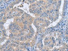RXFP4 / GPR100 Antibody - Immunohistochemistry of paraffin-embedded Human thyroid cancer tissue  using RXFP4 Polyclonal Antibody at dilution of 1:40(×200)
