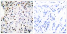 RXRG Antibody - Immunohistochemistry analysis of paraffin-embedded human breast carcinoma tissue, using Retinoid X Receptor gamma Antibody. The picture on the right is blocked with the synthesized peptide.