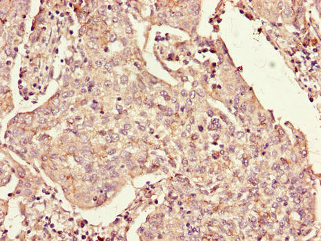 RXRG Antibody - Immunohistochemistry of paraffin-embedded human cervical cancer using RXRG Antibody at dilution of 1:100