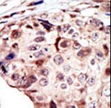 RYK Antibody - Formalin-fixed and paraffin-embedded human cancer tissue reacted with the primary antibody, which was peroxidase-conjugated to the secondary antibody, followed by AEC staining. This data demonstrates the use of this antibody for immunohistochemistry; clinical relevance has not been evaluated. BC = breast carcinoma; HC = hepatocarcinoma.