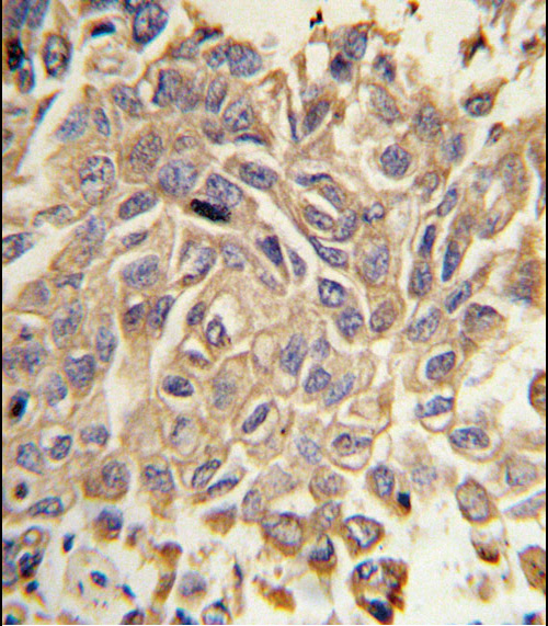 RYK Antibody - Formalin-fixed and paraffin-embedded human lung carcinoma tissue reacted with RYK Antibody, which was peroxidase-conjugated to the secondary antibody, followed by DAB staining. This data demonstrates the use of this antibody for immunohistochemistry; clinical relevance has not been evaluated.