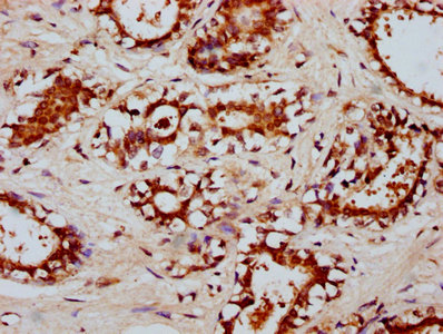 RYK Antibody - Immunohistochemistry Dilution at 1:200 and staining in paraffin-embedded human breast cancer performed on a Leica BondTM system. After dewaxing and hydration, antigen retrieval was mediated by high pressure in a citrate buffer (pH 6.0). Section was blocked with 10% normal Goat serum 30min at RT. Then primary antibody (1% BSA) was incubated at 4°C overnight. The primary is detected by a biotinylated Secondary antibody and visualized using an HRP conjugated SP system.