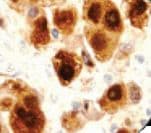 S100 Protein Antibody - IHC of S-100 on FFPE Malignant Melanoma tissue.