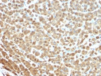 S100A Protein Antibody - IHC testing of FFPE human melanoma stained with S100A antibody (clone S1-61). Required HIER: boil tissue sections in 10mM citrate buffer, pH 6, for 10-20 min followed by cooling at RT for 20 min.