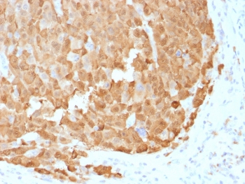S100A1 / S100-A1 Antibody - IHC testing of FFPE human melanoma with S100A1 antibody (clone S100A1/1942). Required HIER: steam sections in 10mM citrate buffer, pH 6, for 10-20 min followed by cooling.