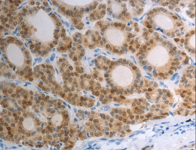 S100A1 / S100-A1 Antibody - Immunohistochemistry of paraffin-embedded Human thyroid cancer using S100A1 Polyclonal Antibody at dilution of 1:40.