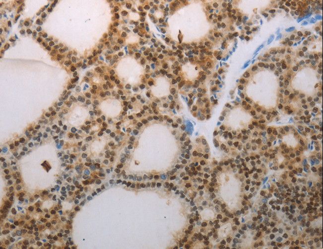 S100A1 / S100-A1 Antibody - Immunohistochemistry of paraffin-embedded Human thyroid cancer using S100A1 Polyclonal Antibody at dilution of 1:70.