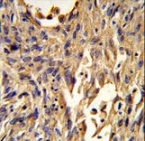 S100A10 Antibody - Formalin-fixed and paraffin-embedded human lung carcinoma reacted with S100A10 Antibody , which was peroxidase-conjugated to the secondary antibody, followed by DAB staining. This data demonstrates the use of this antibody for immunohistochemistry; clinical relevance has not been evaluated.