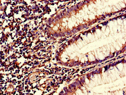 S100A10 Antibody - Immunohistochemistry of paraffin-embedded human colon cancer using S100A10 Antibody at dilution of 1:100