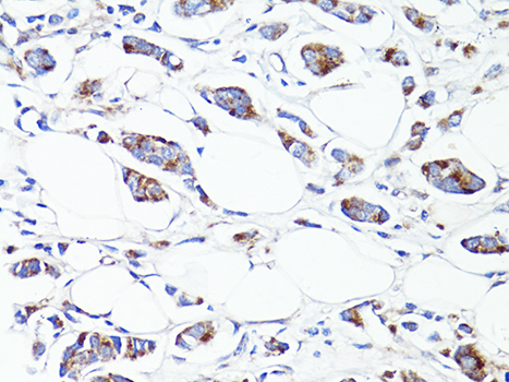 S100A10 Antibody - Immunohistochemistry of paraffin-embedded human breast cancer using S100A10 antibody at dilution of 1:100 (40x lens).