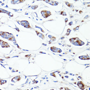 S100A10 Antibody - Immunohistochemistry of paraffin-embedded human mammary cancer using S100A10 antibody at dilution of 1:100 (40x lens).