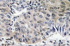 S100A10 Antibody - IHC of S-100A10 (V52) pAb in paraffin-embedded human lung carcinoma tissue.