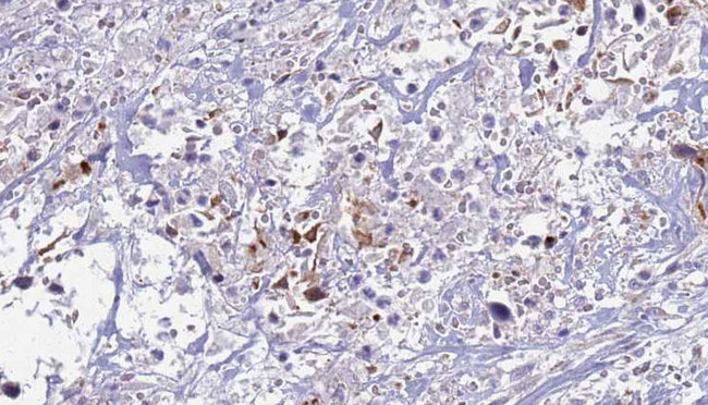 S100A12 Antibody - 1:100 staining human urothelial carcinoma tissue by IHC-P. The sample was formaldehyde fixed and a heat mediated antigen retrieval step in citrate buffer was performed. The sample was then blocked and incubated with the antibody for 1.5 hours at 22°C. An HRP conjugated goat anti-rabbit antibody was used as the secondary.