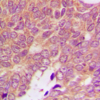 S100A16 Antibody - Immunohistochemical analysis of S100-A16 staining in human breast cancer formalin fixed paraffin embedded tissue section. The section was pre-treated using heat mediated antigen retrieval with sodium citrate buffer (pH 6.0). The section was then incubated with the antibody at room temperature and detected using an HRP conjugated compact polymer system. DAB was used as the chromogen. The section was then counterstained with hematoxylin and mounted with DPX.