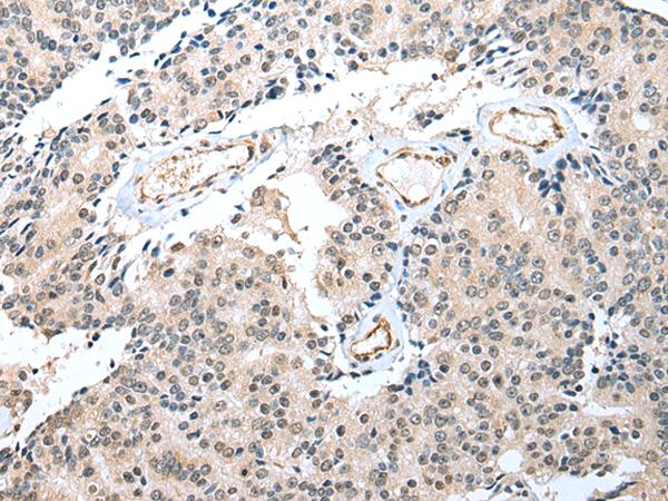 S100A16 Antibody - Immunohistochemistry of paraffin-embedded Human prost at e cancer tissue  using S100A16 Polyclonal Antibody at dilution of 1:25(×200)