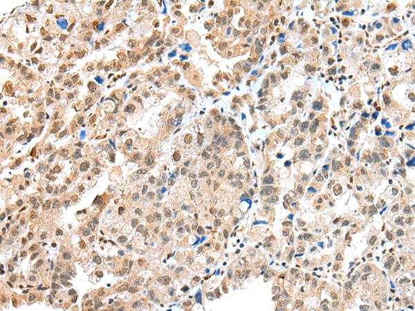 S100A16 Antibody - Immunohistochemistry of paraffin-embedded Human ovarian cancer tissue  using S100A16 Polyclonal Antibody at dilution of 1:25(×200)