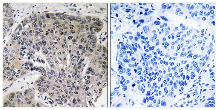 S100A3 / S100E Antibody - Peptide - + Immunohistochemistry analysis of paraffin-embedded human lung carcinoma tissue, using S100A3 antibody.