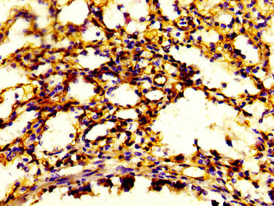 S100A4 / FSP1 Antibody - IHC image of S100A4 Antibody diluted at 1:600 and staining in paraffin-embedded human lung tissue performed on a Leica BondTM system. After dewaxing and hydration, antigen retrieval was mediated by high pressure in a citrate buffer (pH 6.0). Section was blocked with 10% normal goat serum 30min at RT. Then primary antibody (1% BSA) was incubated at 4°C overnight. The primary is detected by a biotinylated secondary antibody and visualized using an HRP conjugated SP system.